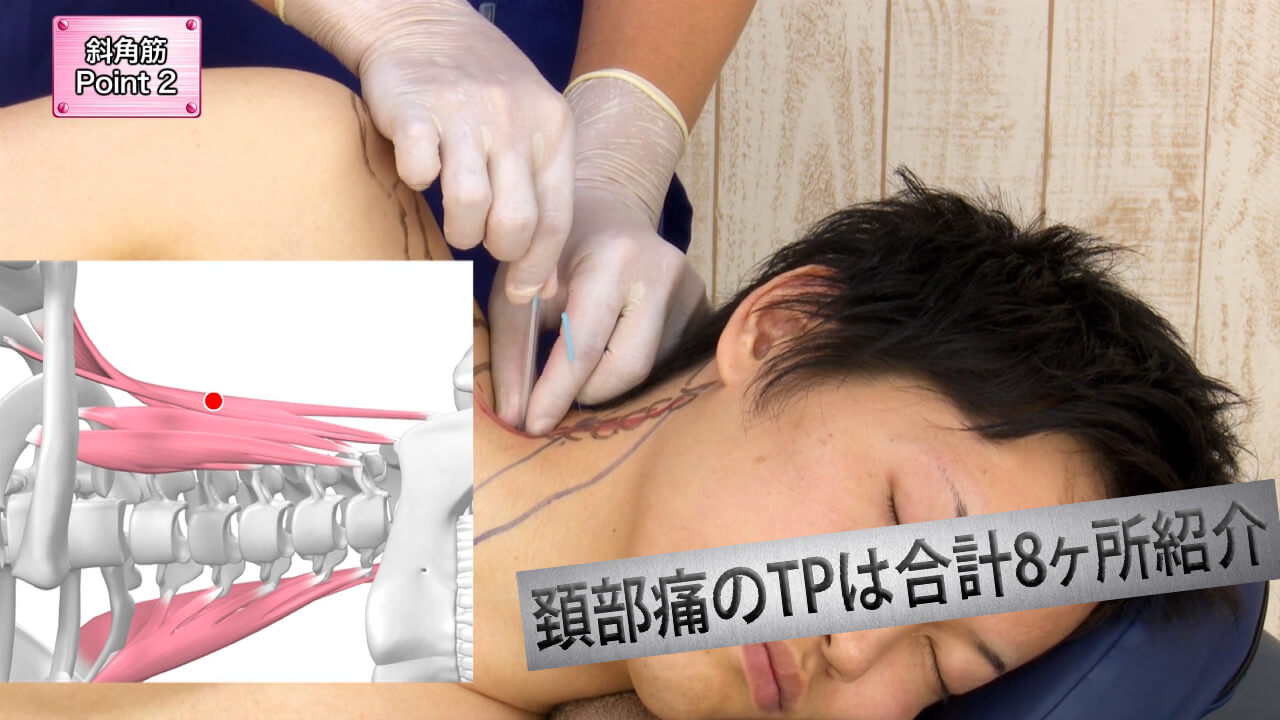 【DVD】CGでわかる 腰痛・頚部痛に効く トリガーポイント鍼療法 森田スタイル