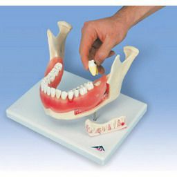 歯と歯茎の疾患モデル　D26