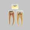 虫歯の大臼歯模型
